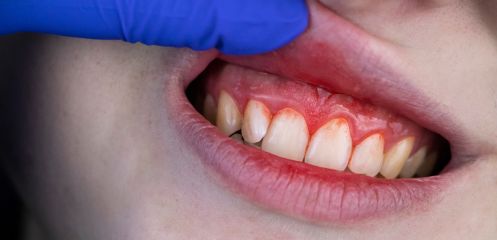 Bleeding gums